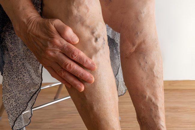 Niewydolność żylna i żylaki - kompresjoterapia