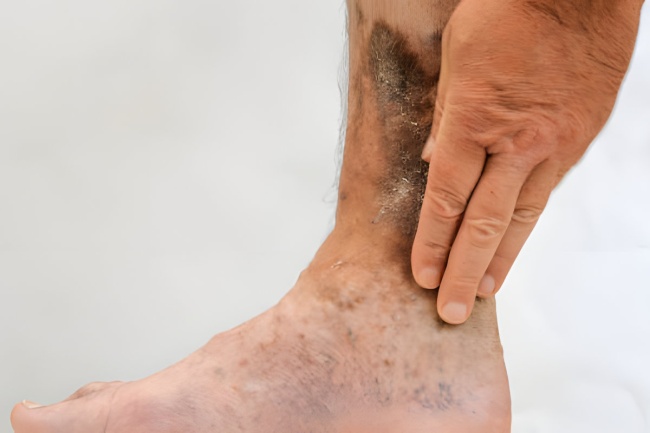 Owrzodzenia żylne kończyn dolnych